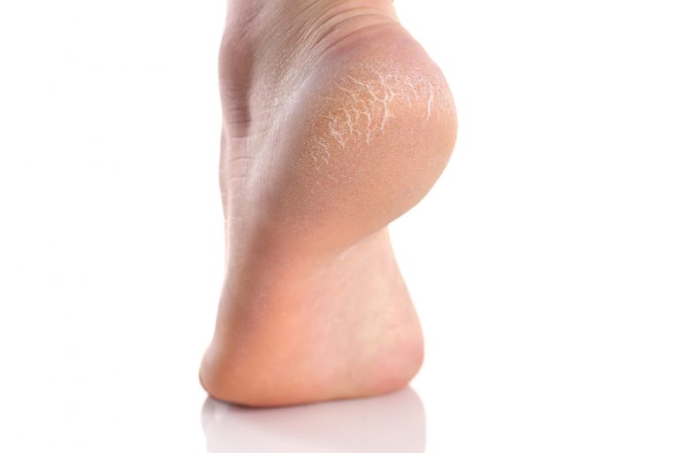 薬剤師伝授 頑固なガサガサかかと 原因と根本的に治す方法 Beautyまとめ